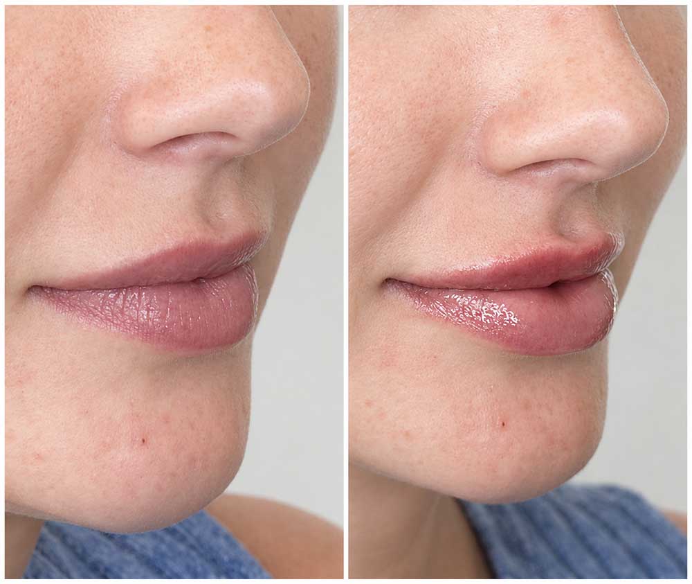 Natural Looking Lip Fillers in Nashville — How to Get Results That Actually Look Like You