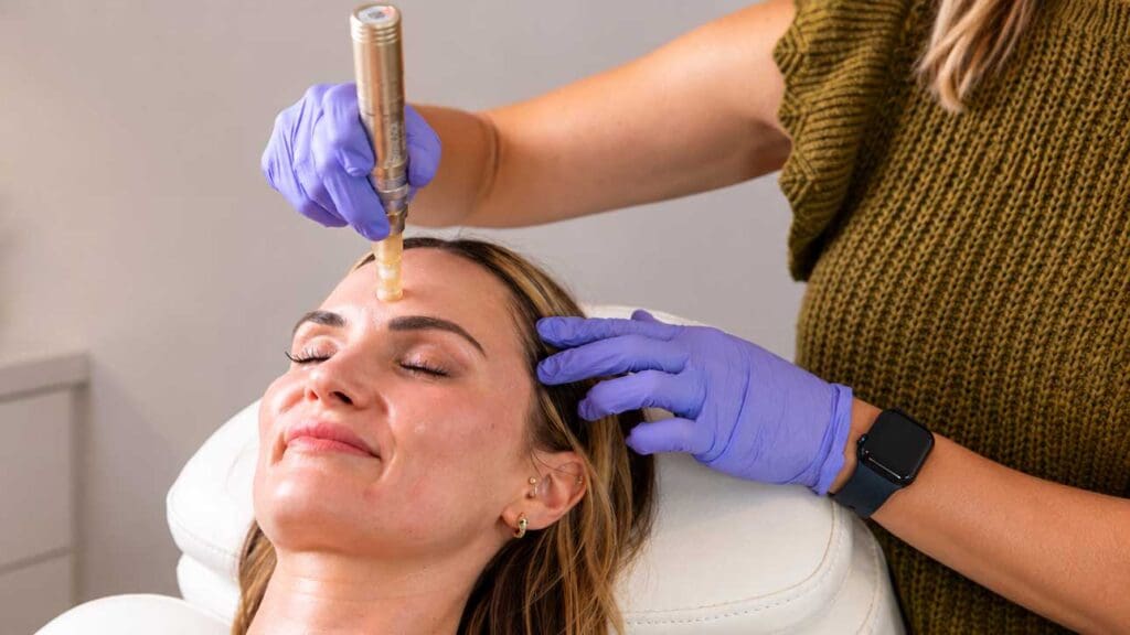 Microneedling builds collagen faster and more directly than chemical peels