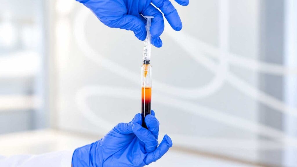 PRF Facials by using small sample of blood